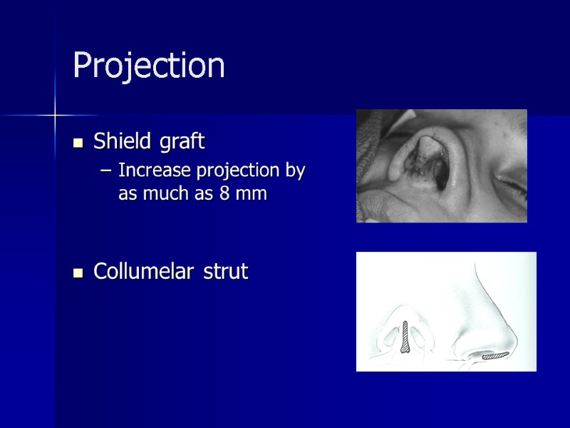 Projection Shield graft Increase projection by as much as 8 mm   Collumelar